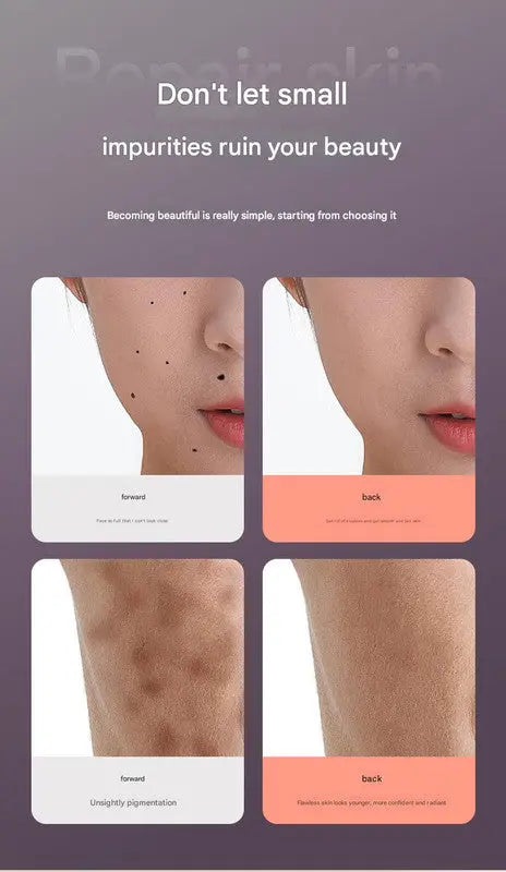 Professional Electric Mole & Dark Spot Remover Pen - Advanced Plasma Ion Technology for Seamless Skin Tag & Freckle Removal (Purple) Wholesale Hub